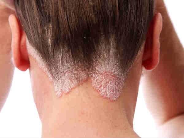 Bật mí tất cả các cách trị nấm da đầu tận gốc